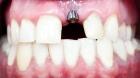 Diseñada una nanopartícula capaz de prevenir la periimplantitis en los implantes dentales