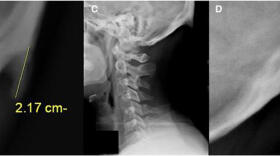 ¿Por qué nos está creciendo una espina de hueso en el cráneo?