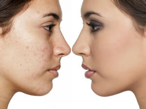 Productos y consejos para tapar las marcas de acné