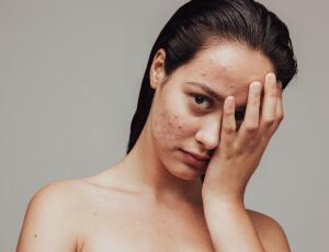 Qué es el acné cosmético, cómo evitarlo y paliarlo