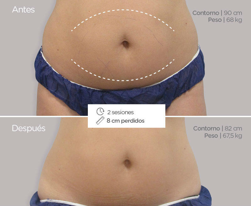 Criolipolisis en mujer. Antes y después del tratamiento